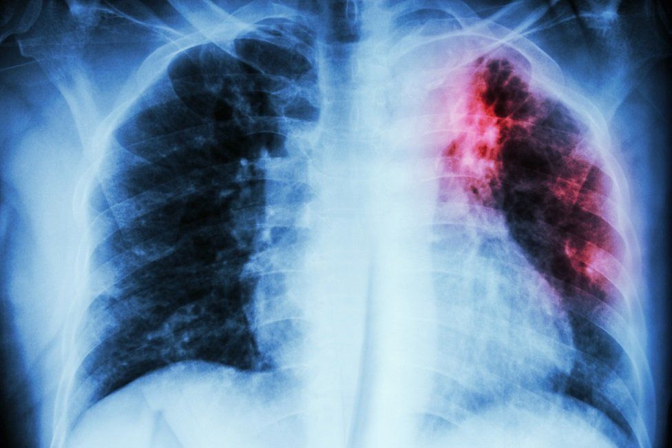 X-ray changes of cystic fibrosis