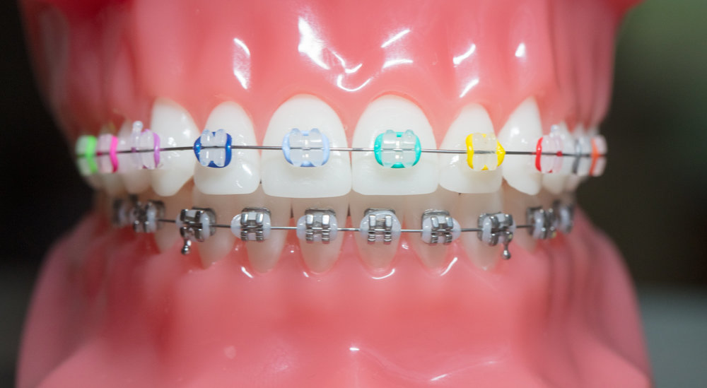 A Guide to the Different Colors of Braces Learn Loft Blog