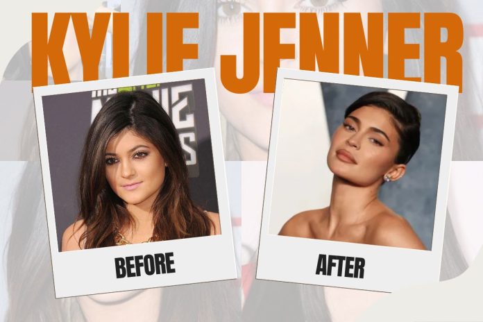 Kylie Jenner Before Plastic Surgery