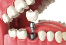8 Warning Signs You Might Need Dental Implants ASAP 8 signs that you need dental implants
